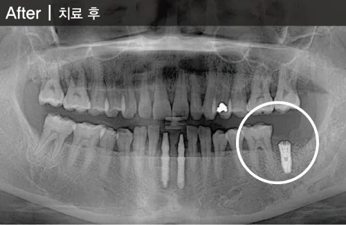 BMP를 이용한 심한 풍치환자에서 발치 후 즉시식립 치료 후